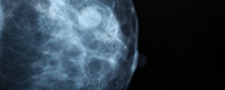 CQ-index mammacare op de internationale kwaliteitskaart