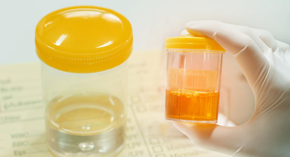 Nivel: One in twelve adults has diagnosis of chronic kidney disease 